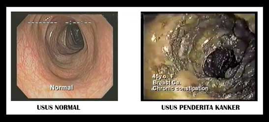 usus normal dan usus penderita kanker payudara