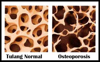 osteoporosis