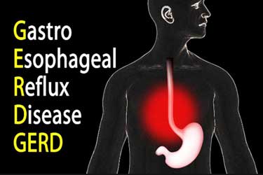 gerd acid reflux