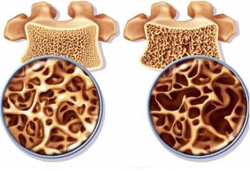 tulang osteoporosis